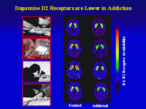 Hijacked Brain Dopamine 2 Receptors lower